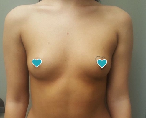 Breast lift, breast implants, breast reduction plastic surgery Salt Lake City Utah