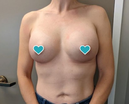 Selarom plastic surgery and medical spa Salt Lake City Utah breast lift, breast implants, breast augmentation, butt lift, liposuction, botox, neck lift, nose surgery
