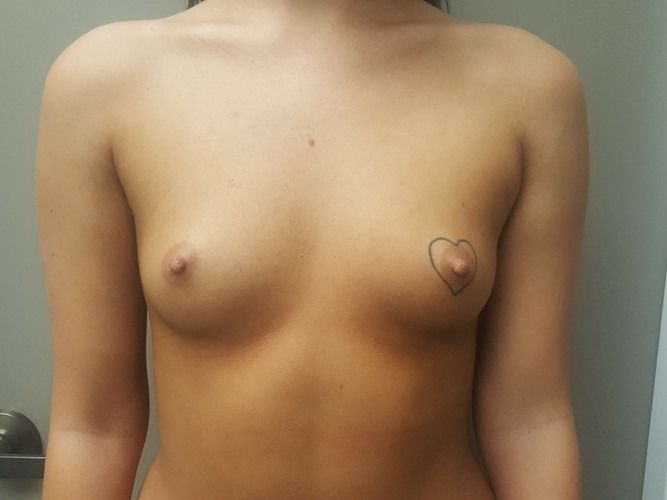 Breast lift, breast implants, breast reduction plastic surgery Salt Lake City Utah